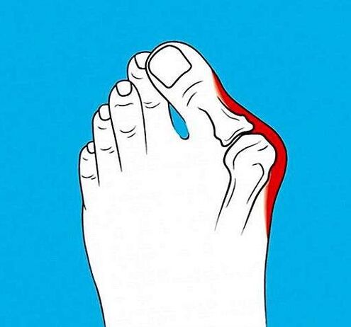 artrose da articulação do dedo do pé