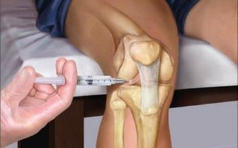 injeção intra-articular na articulação para artrose