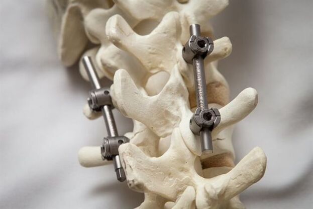 fixação da osteocondrose da coluna vertebral do pescoço