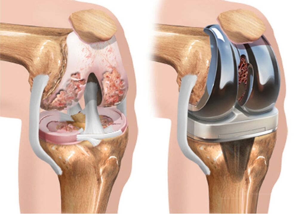 antes e depois da artrose da articulação do joelho para artrose