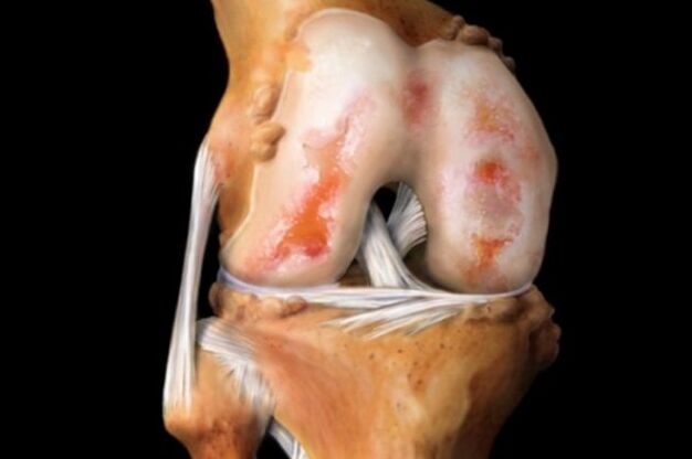 dano à cartilagem na artrose do joelho