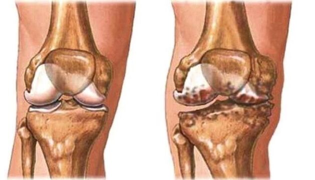 joelho saudável e artrose de joelho