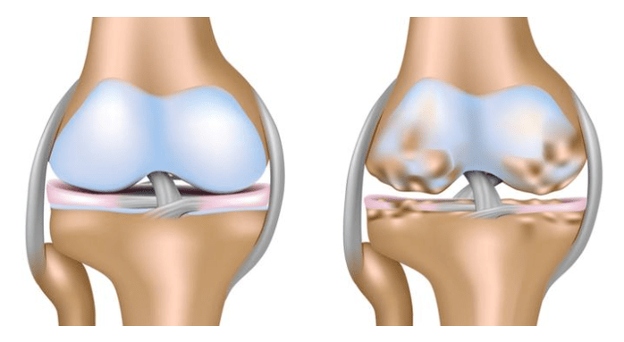 cartilagem saudável e danos à articulação do joelho com artrose
