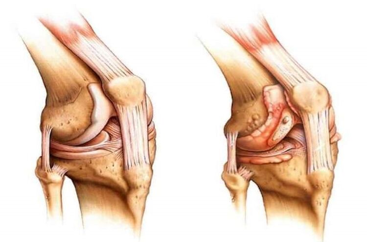 joelho saudável e artrose da articulação do joelho