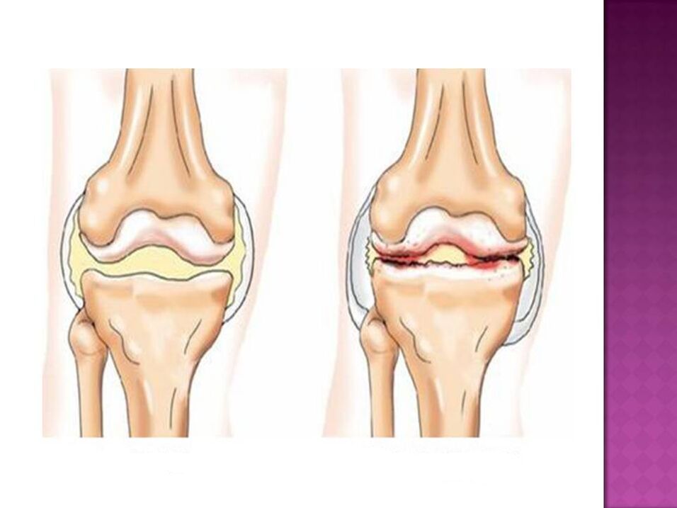A articulação é normal (esquerda) e afetada pela osteoartrite (direita)