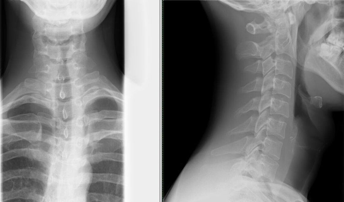 A radiografia da coluna vertebral é um método simples e eficaz para diagnosticar osteocondrose