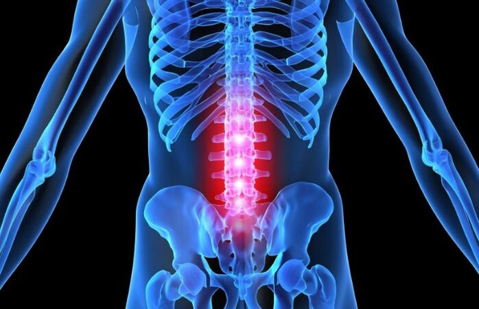 Osteocondrose da região lombar