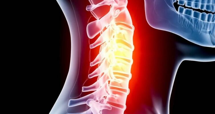 Inflamação da região cervical