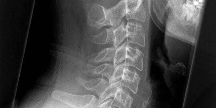 Uma foto da região cervical