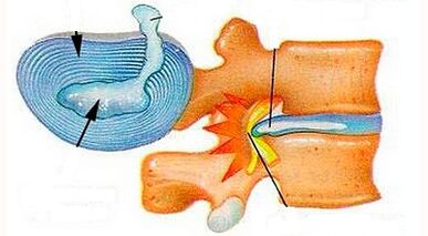 Características do desenvolvimento da osteocondrose cervical