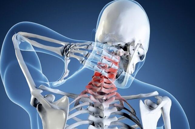 osteocondrose da coluna cervical